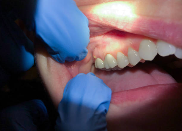 Best Emergency Tooth Extraction in Westphalia, MD